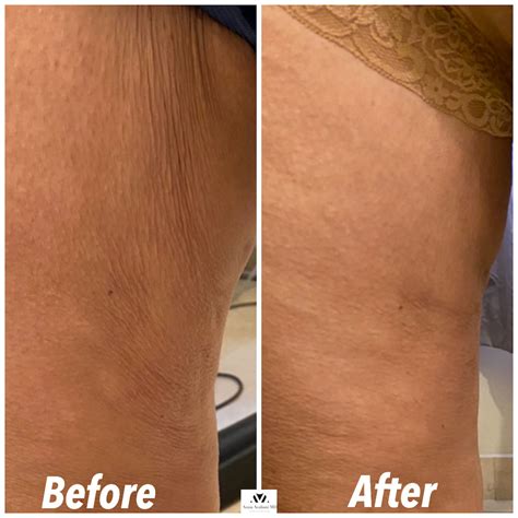 BEFOREAFTER; MONTHLY SPECIALS. . Sculptra legs before and after